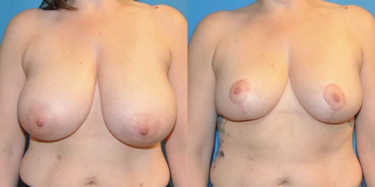 Breast Reduction #14 - Before and After