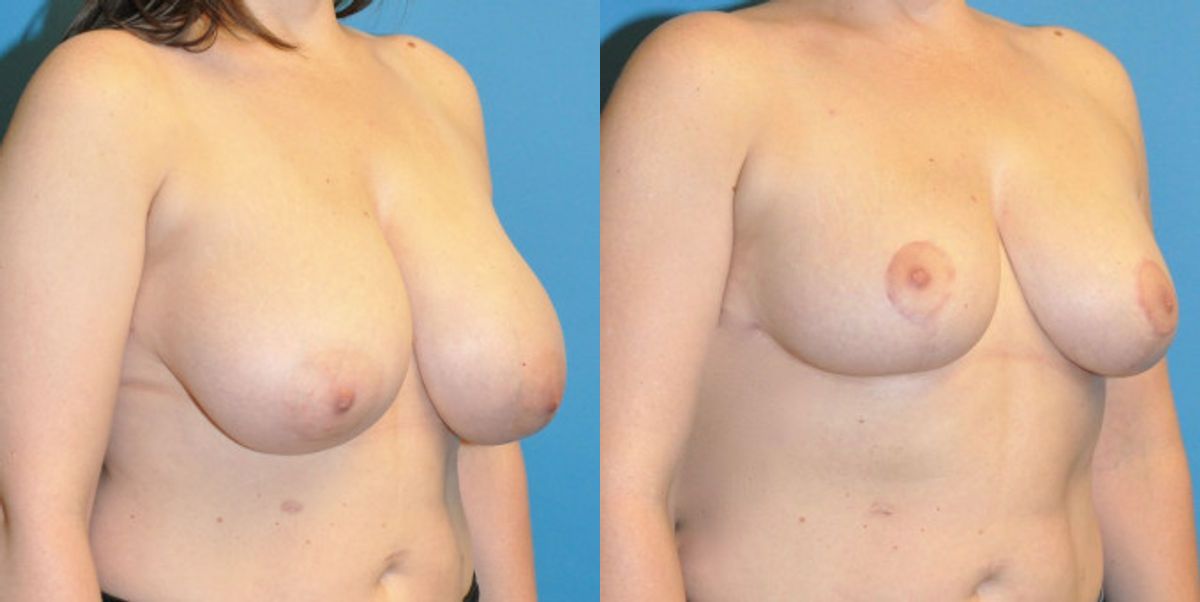 Breast Reduction #14 - Before and After