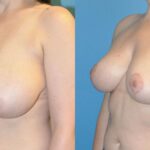 Breast Reduction #14 - Before and After