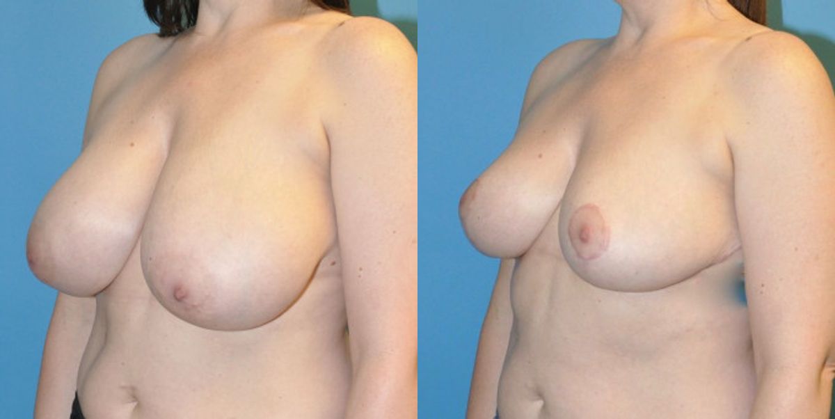 Breast Reduction #14 - Before and After