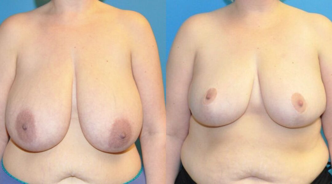 Breast Reduction #15