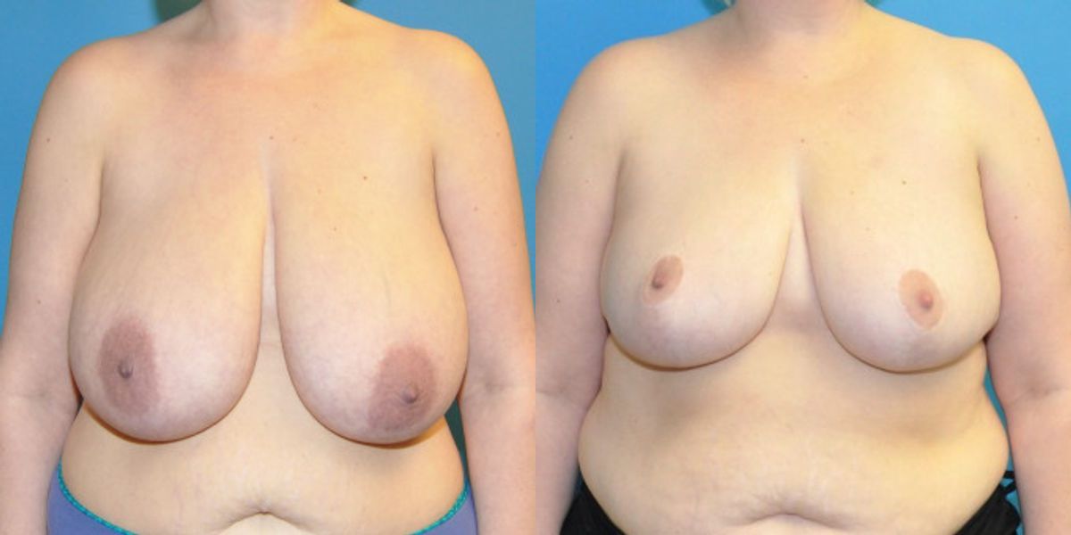 Breast Reduction #15 - Before and After