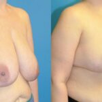 Breast Reduction #15 - Before and After