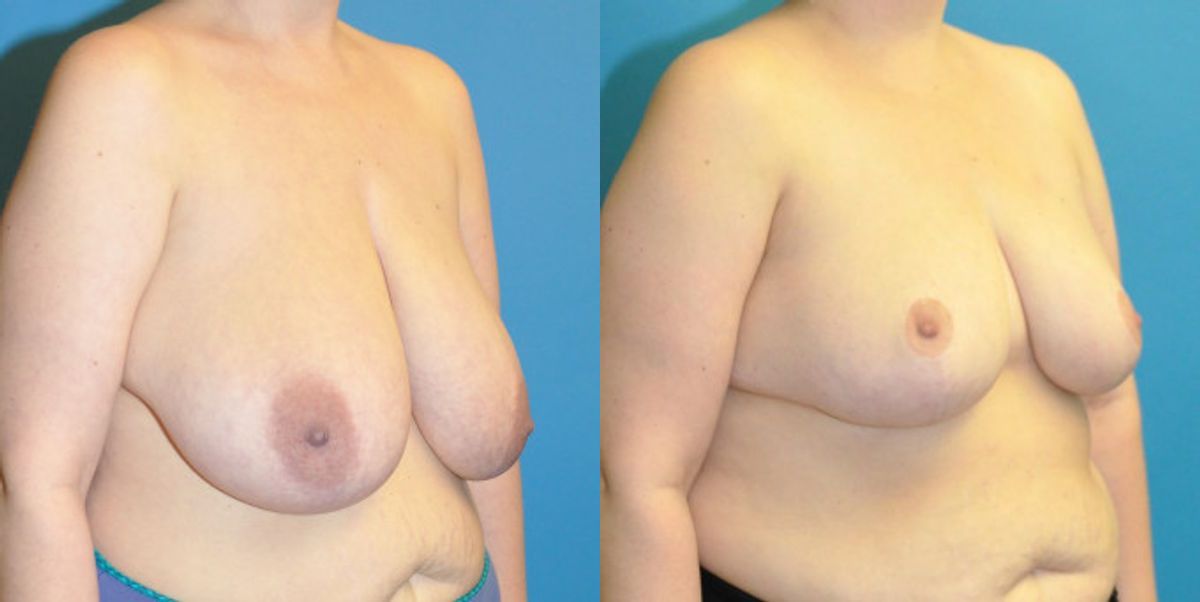 Breast Reduction #15 - Before and After