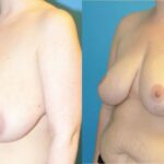 Breast Reduction #15 - Before and After