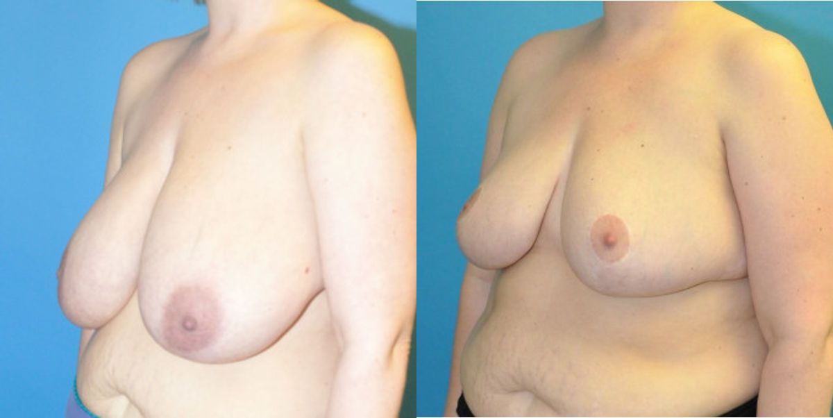 Breast Reduction #15 - Before and After