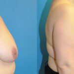 Breast Reduction #15 - Before and After