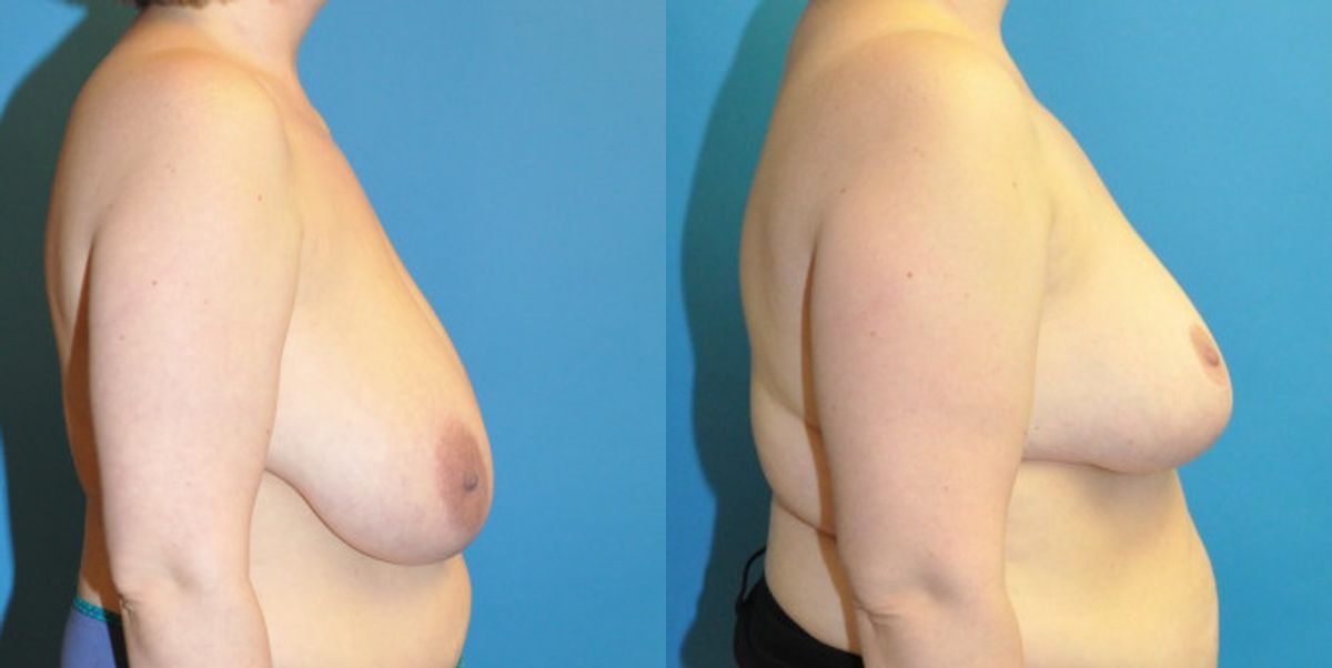 Breast Reduction #15 - Before and After