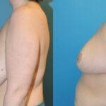 Breast Reduction #15 - Before and After