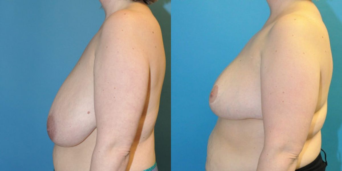 Breast Reduction #15 - Before and After