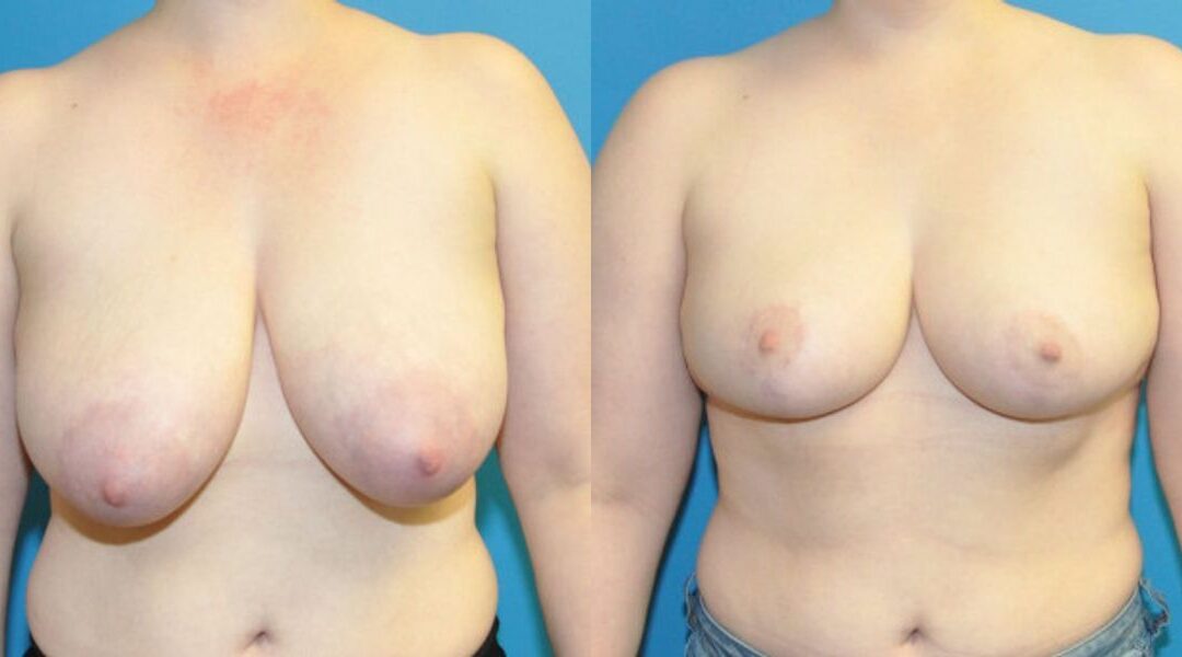 Breast Reduction #16