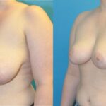 Breast Reduction #16 - Before and After