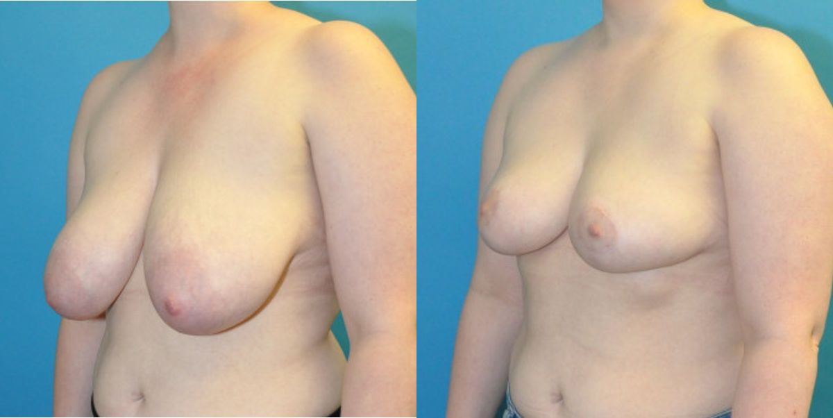 Breast Reduction #16 - Before and After