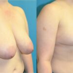 Breast Reduction #16 - Before and After