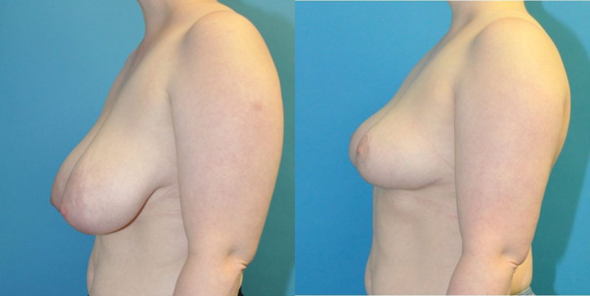 Breast Reduction #16 - Before and After