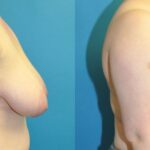 Breast Reduction #16 - Before and After