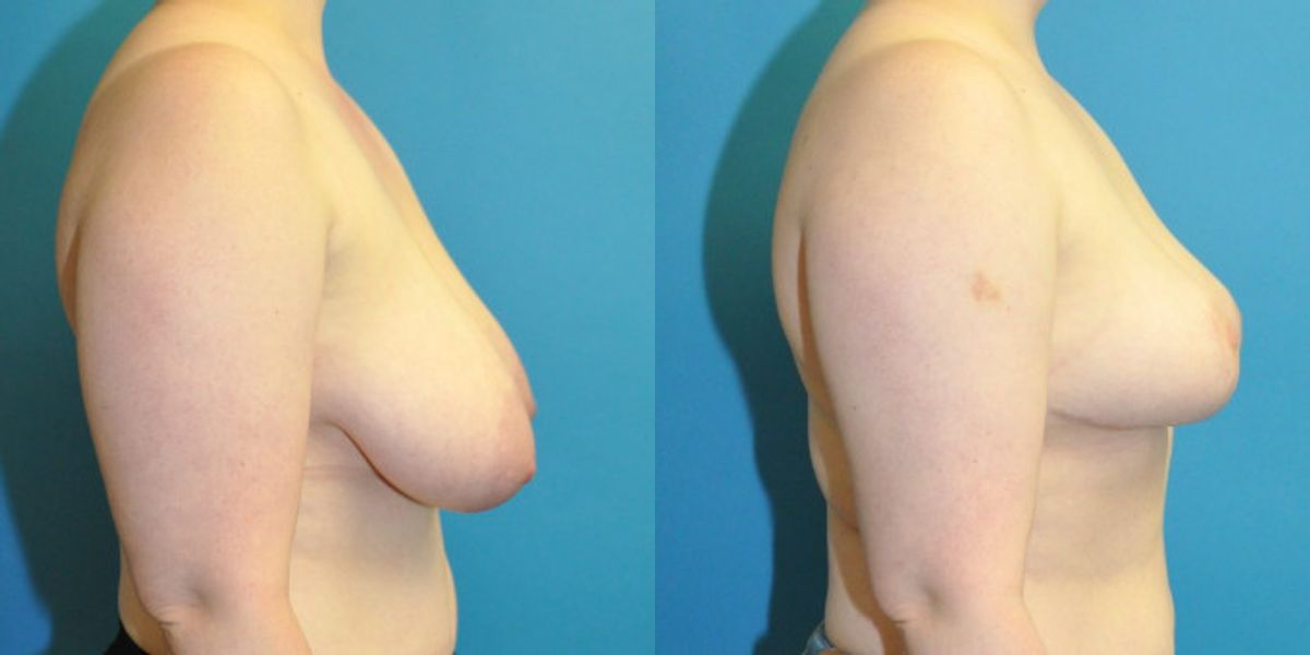 Breast Reduction #16 - Before and After