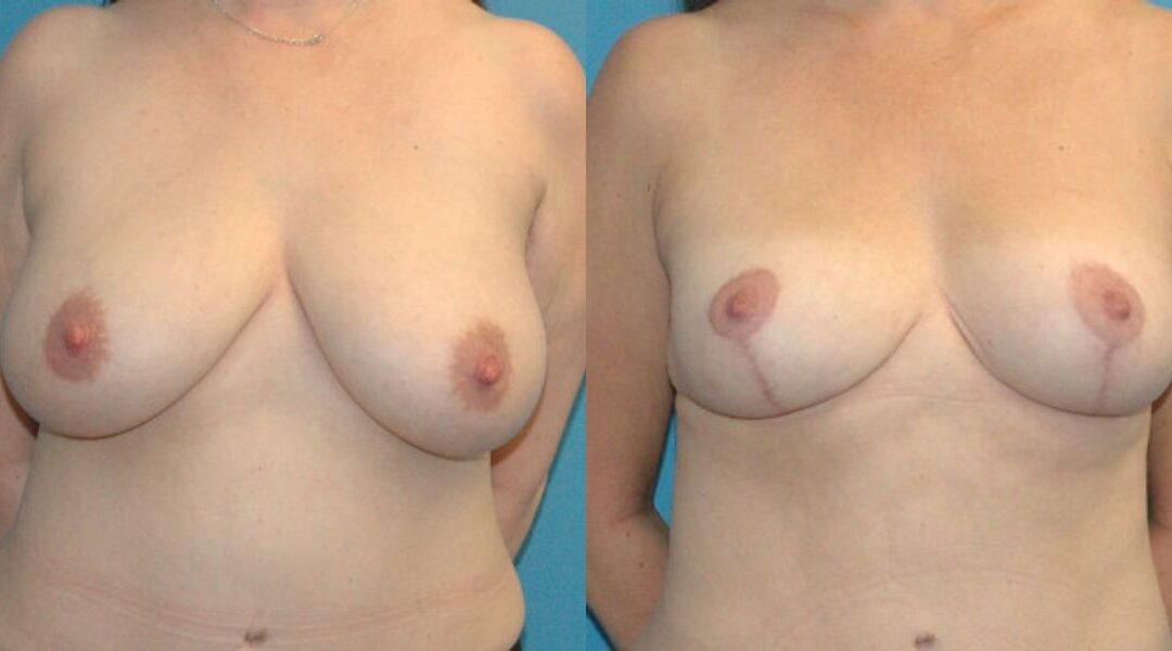 Breast Reduction #17