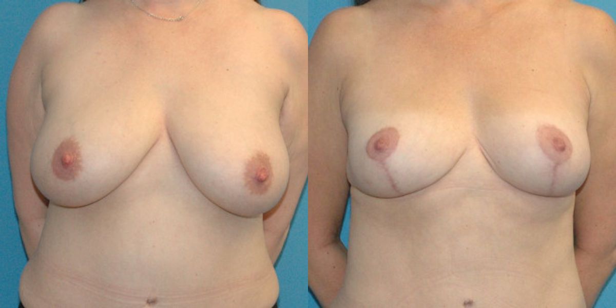 Breast Reduction #17 - Before and After