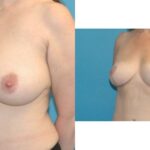 Breast Reduction #17 - Before and After