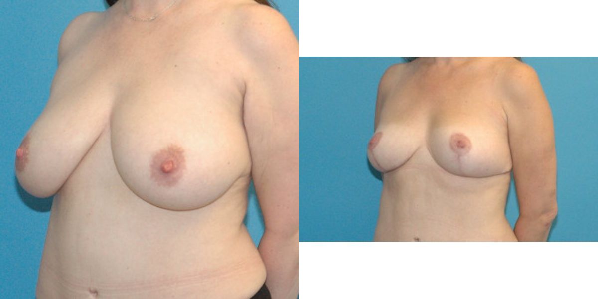 Breast Reduction #17 - Before and After