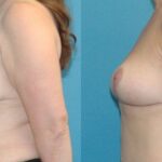 Breast Reduction #17 - Before and After