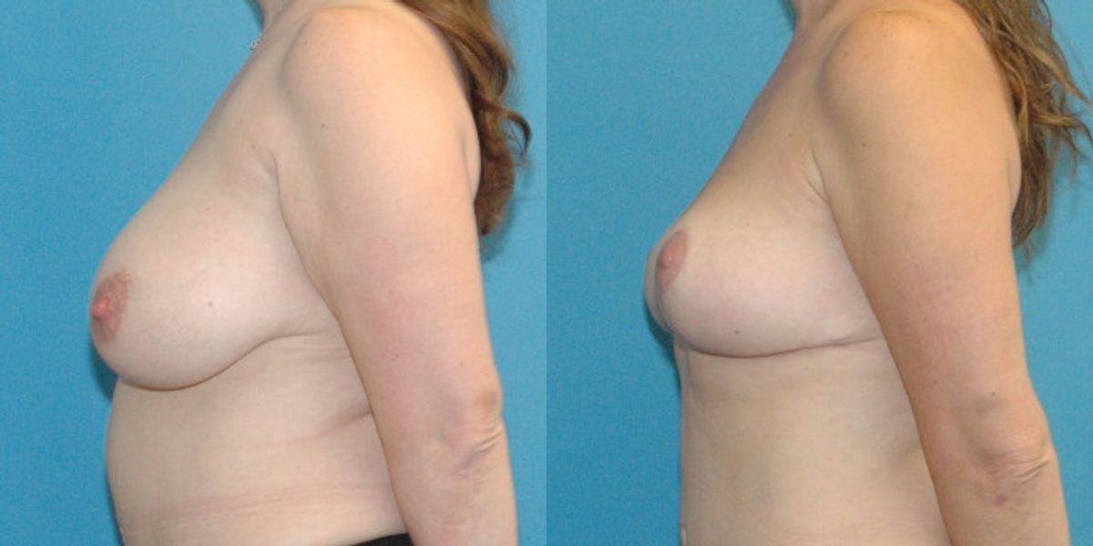 Breast Reduction #17 - Before and After
