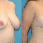 Breast Reduction #17 - Before and After