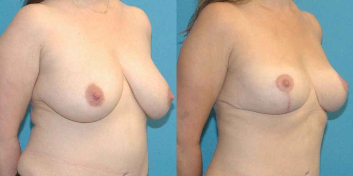 Breast Reduction #17 - Before and After