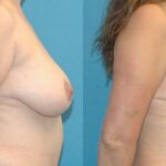 Breast Reduction #17 - Before and After