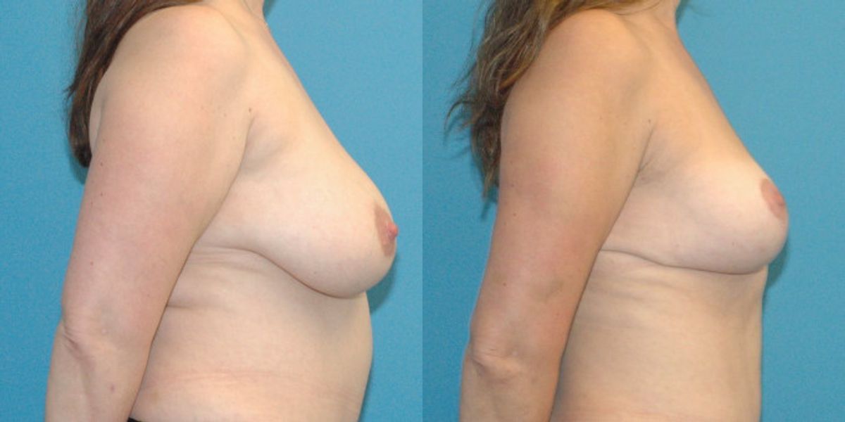 Breast Reduction #17 - Before and After