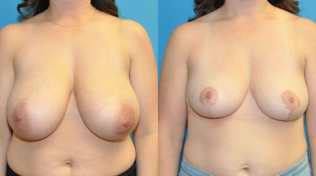 Breast Reduction #18