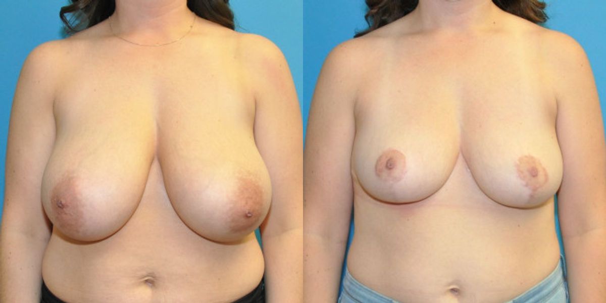 Breast Reduction #18 - Before and After