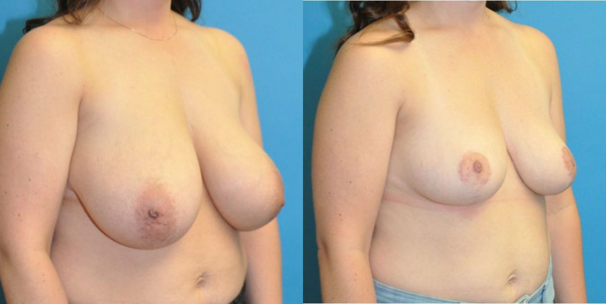 Breast Reduction #18 - Before and After