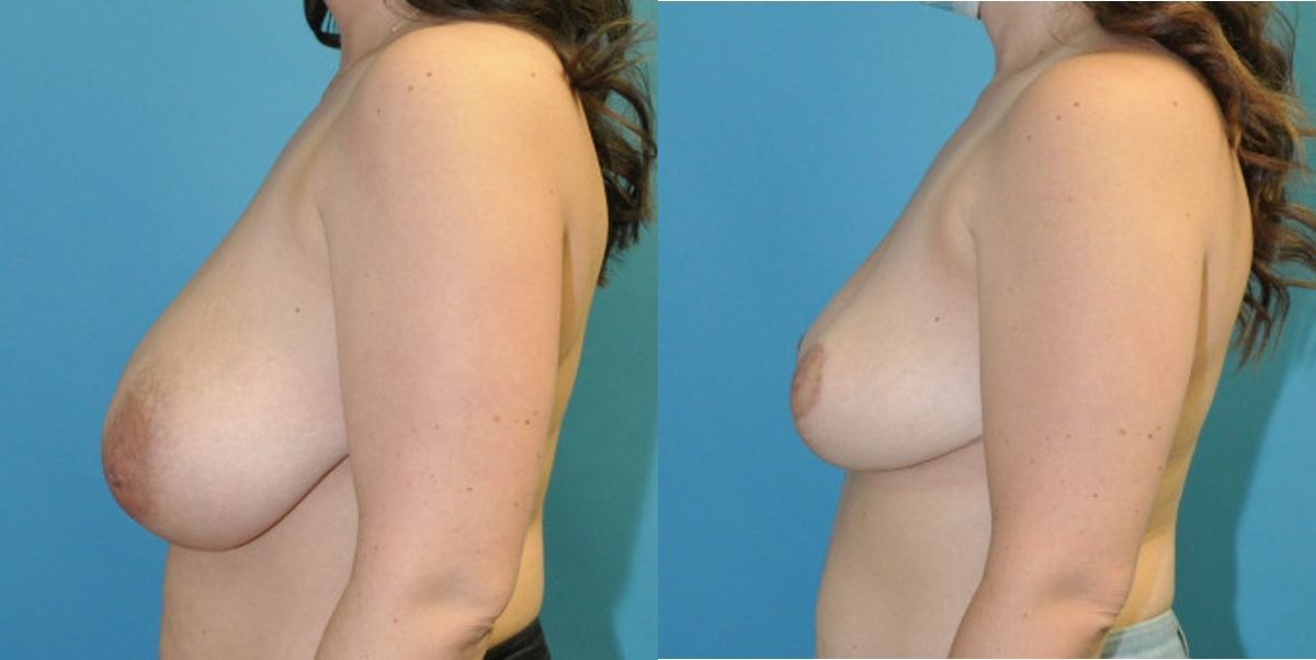 Breast Reduction #18 - Before and After