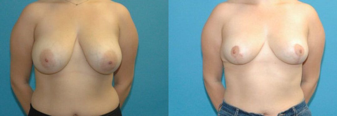 Breast Reduction #19
