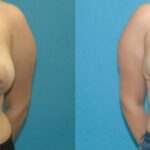 Breast Reduction #19 - Before and After
