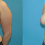 Breast Reduction #19 - Before and After