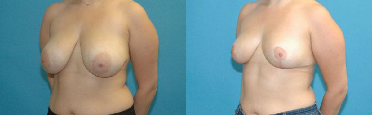 Breast Reduction #19 - Before and After
