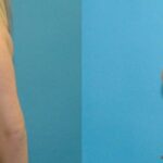 Breast Reduction #19 - Before and After