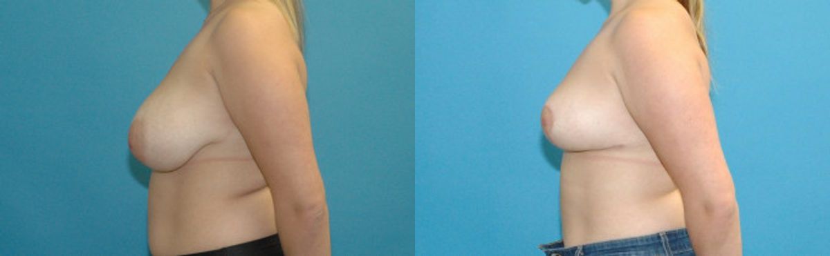 Breast Reduction #19 - Before and After
