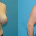 Breast Reduction #19 - Before and After