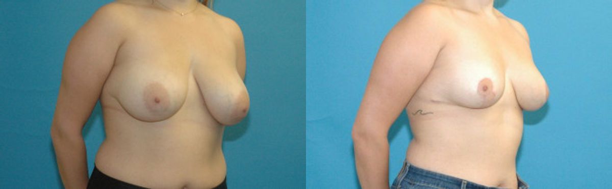 Breast Reduction #19 - Before and After