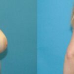 Breast Reduction #19 - Before and After