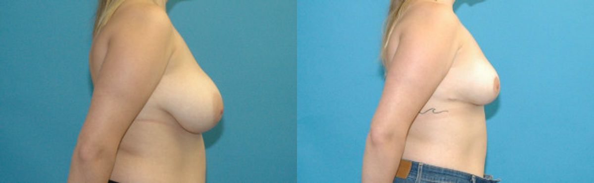 Breast Reduction #19 - Before and After