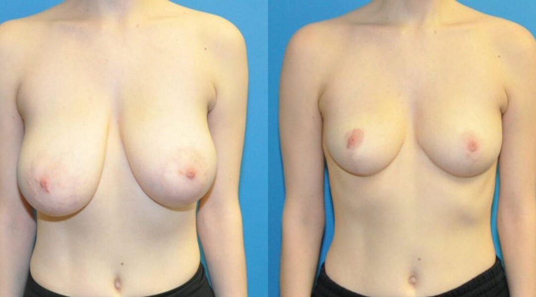 Breast Reduction #20