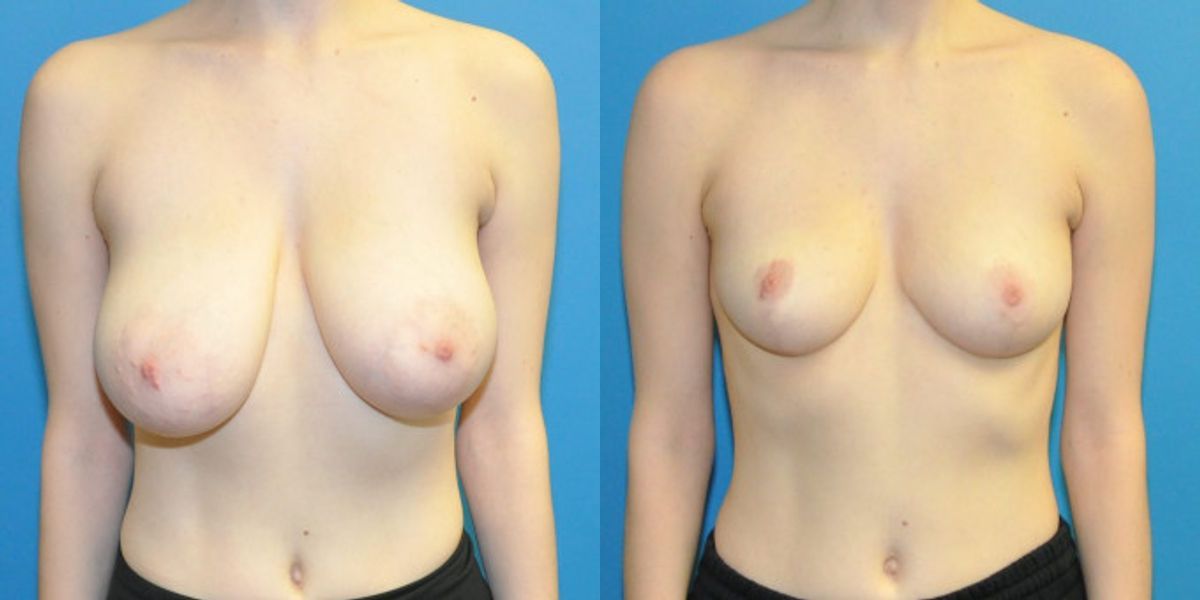 Breast Reduction #20 - Before and After