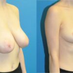 Breast Reduction #20 - Before and After