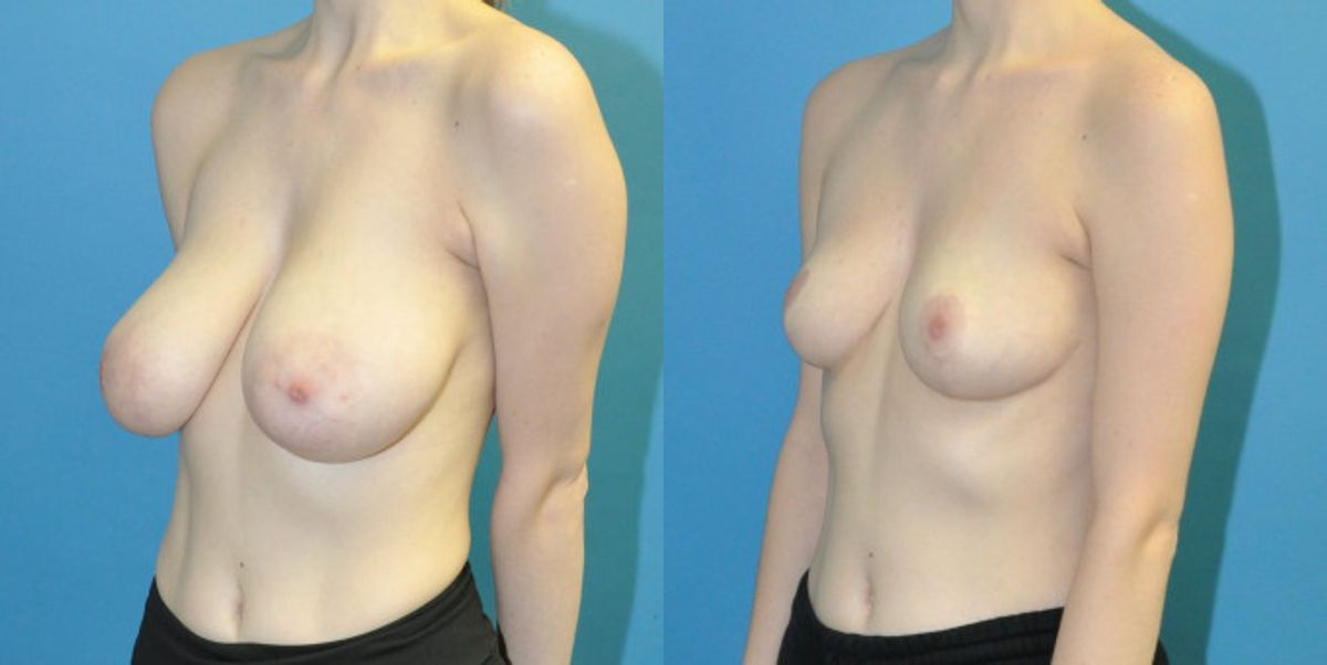 Breast Reduction #20 - Before and After