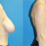 Breast Reduction #20 - Before and After
